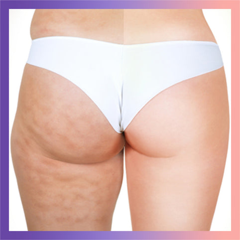 Cellulite Treatment